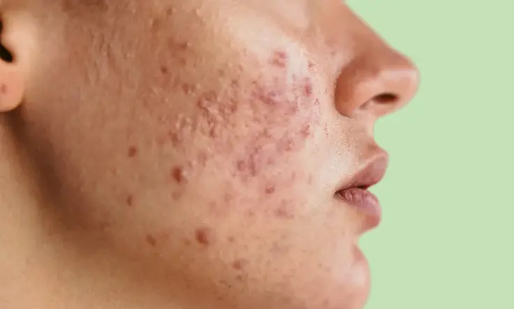 Find the best acne scar treatments to improve skin texture and achieve clear, radiant skin.