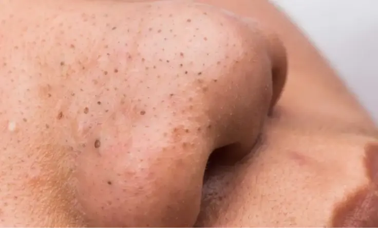 Find the most effective treatments to eliminate blackheads and whiteheads for flawless skin.