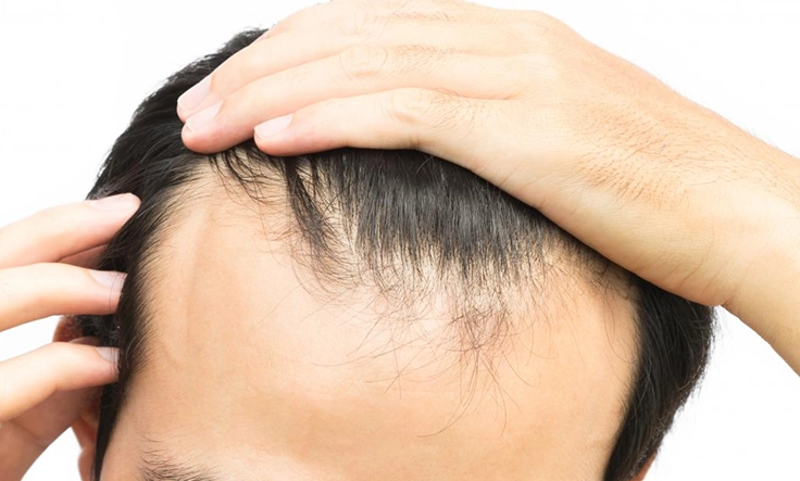 Hairline recession caused by nutrient deficiency and stress after sudden weight loss.