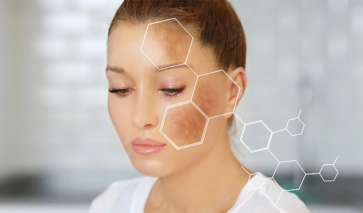 Most particular parts of the skin produce excessive pigment, resulting in hyperpigmentation.