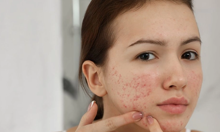 Effective treatments for acne picking and prevention to help you achieve clear, smooth skin