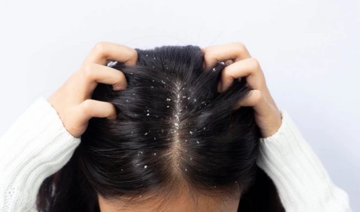 Identifying major dandruff causes, dry skin, dermatitis, poor hygiene, and effective treatment.