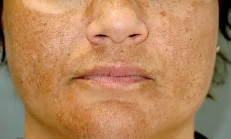 Discover effective hyperpigmentation treatments for acne scars and dark spots for clearer skin