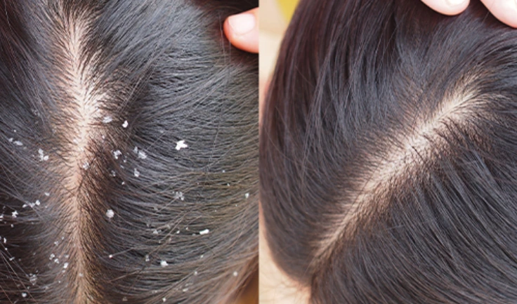 Identifying how poor hygiene causes dandruff, symptoms, and effective treatments for a healthy scalp