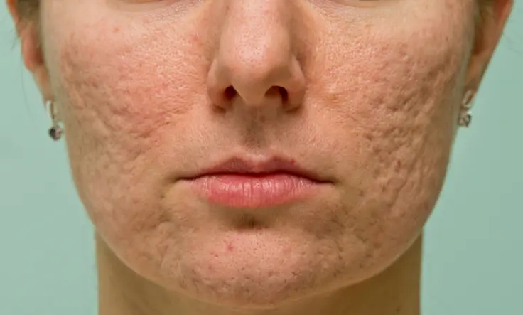 Discover the best acne scarring treatments to reduce marks and restore smooth, flawless skin.