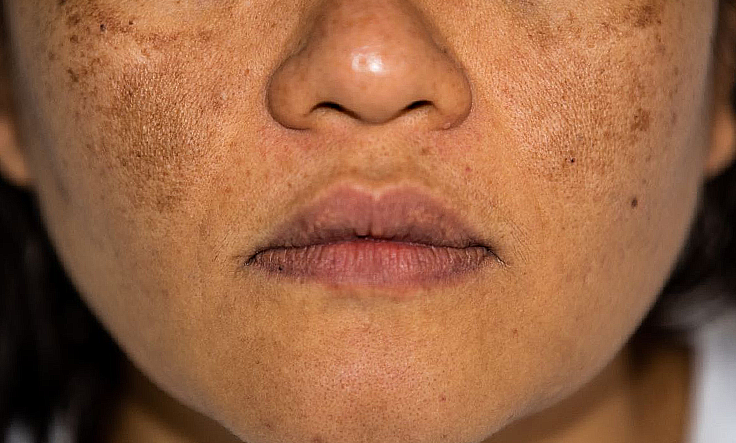 Before and after results of skin treatment showing reduced pigmentation & improved skin tone.