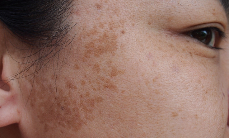 Close-up of skin pigmentation before treatment, showing dark spots and uneven skin texture.