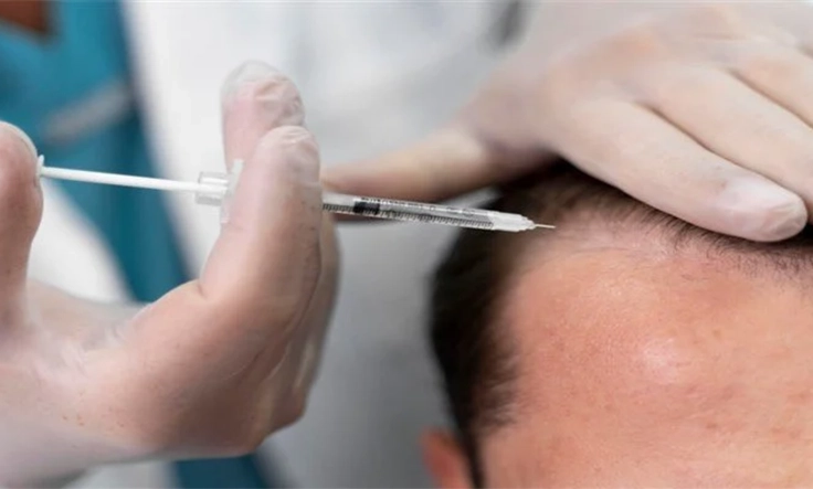 A medical professional administering an injection for hair restoration in a patient’s scalp.