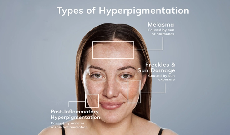 Most particular parts of the skin produce excessive pigment, resulting in hyperpigmentation.