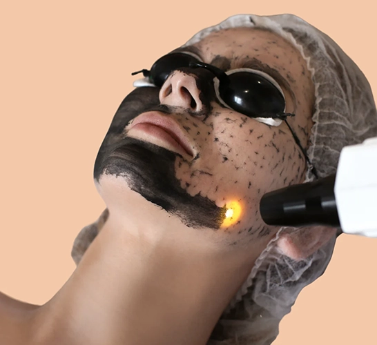  A carbon laser peel procedure reducing acne, pigmentation, and hair, revealing smoother, brighter skin.