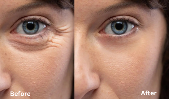 Results of smooth and wrinkle-free skin rejuvenation with our effective anti-aging treatments